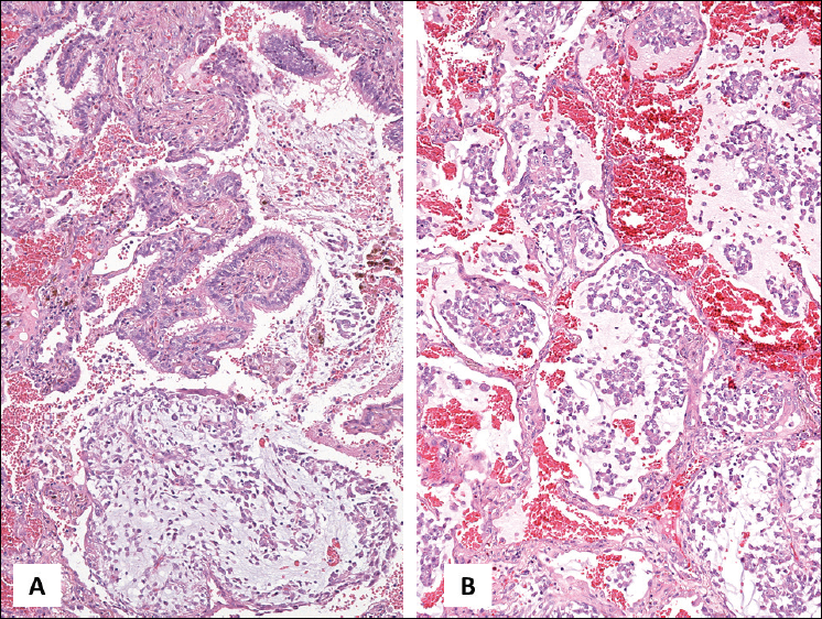 2015 World Health Organization Classification Of Lung Tumors New